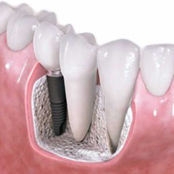 http://asreesfahan.com/AdvertisementSites/1398/08/23/main/implant.jpg
