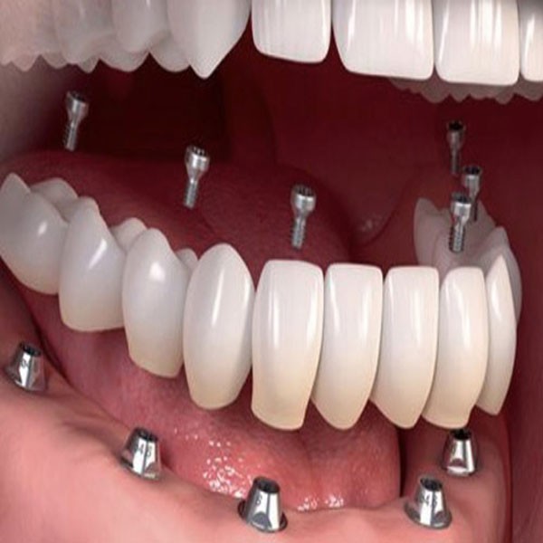 لمینت دندان ، کامپوزیت دندان ،  ایمپلنت دندان